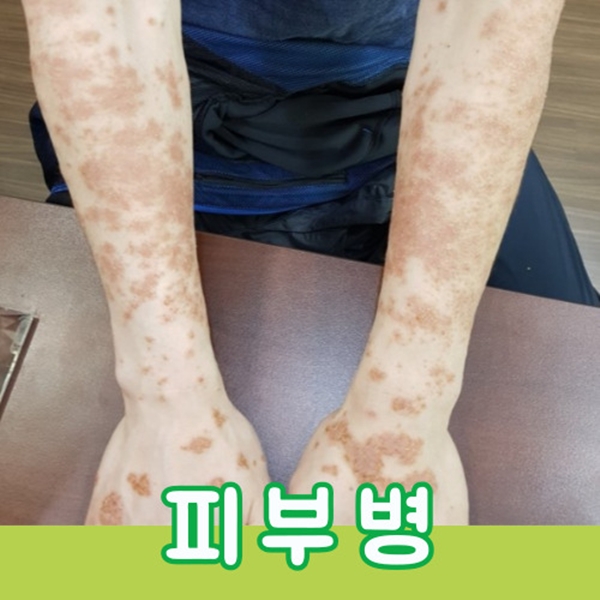 피부병 바디리모델링